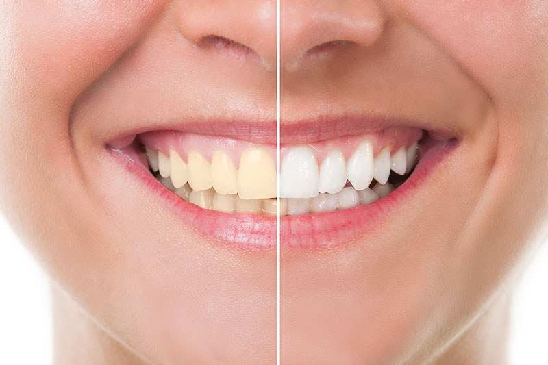 Teeth Whitening in Des Plaines